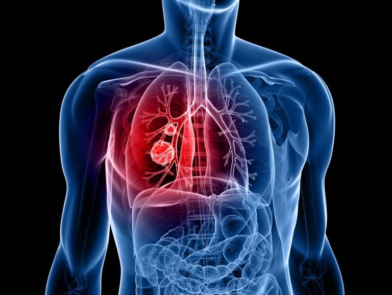 Common Causes of Lung Cancer - Detailed Review!